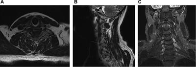 Multiple myeloma presenting as a cervical intraforaminal tumor: A case report and review of literature